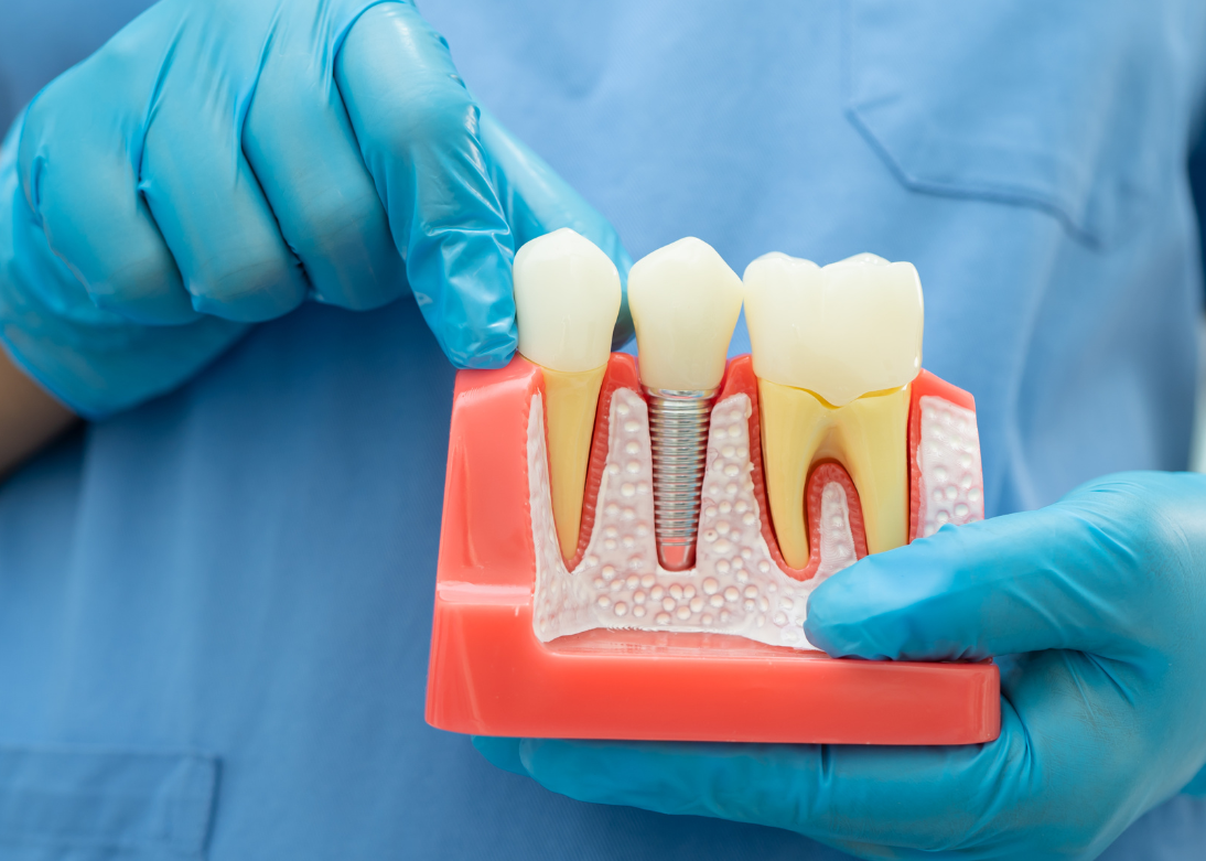 Root Canal Treatment