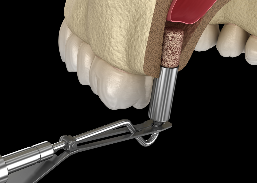 Gingival Surgeries